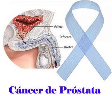 Factores de Riesgo para el Cáncer de Próstata