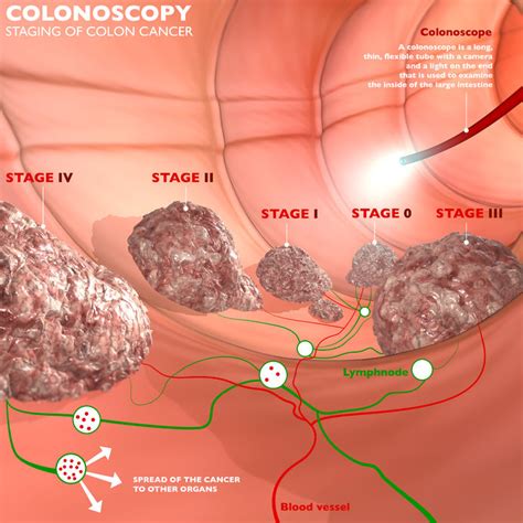 Failure To Diagnose Colon Cancer In High Risk Patient