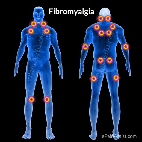 FAQ on Fibromyalgia|Symptoms|11 Painful Trigger Points ...