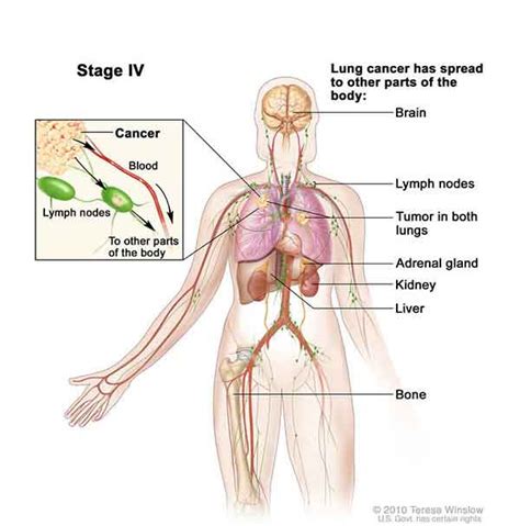 FDA Expands Crizotinib Approval   National Cancer Institute