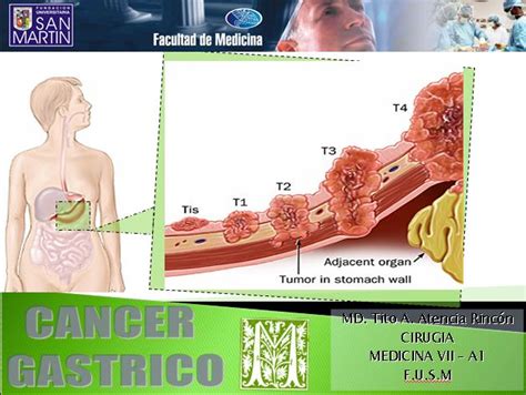 febrero | 2013 | cancer Gastrico