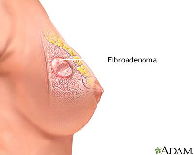 Fibroadenoma: MedlinePlus enciclopedia médica illustración