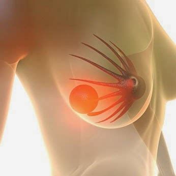 Fibroadenomas: ¿pueden transformarse en cáncer de mama ...