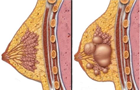 Fibrocystic breast disease; Breast Dysplasia; Fibrocystic ...