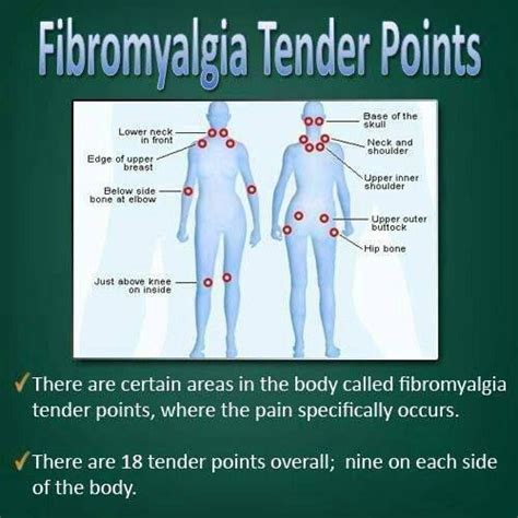 Fibromyalgia Tender Points | Living w/ Chronic Pain ...