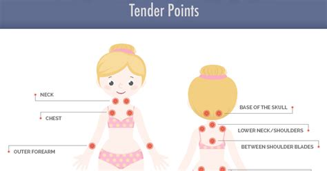 Fibromyalgia Tender Points: What and Where Are the Tender ...