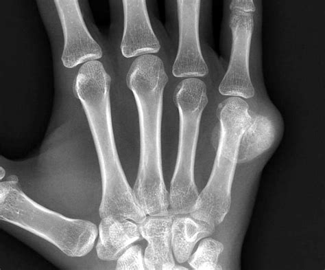 Fifth Metacarpal Fracture   Fracture Treatment