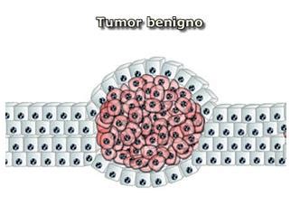 Figura 1.2 Imagen que representa a dos tipos tumores. En A ...