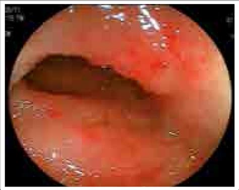 Figura 1. Mucosa de íleon terminal eritematosa y ...