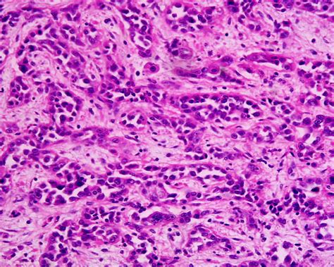 File:Adenocarcinoma low differentiated  stomach  H&E magn ...