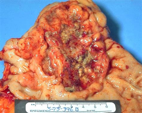 File:Adenocarcinoma, stomach, gross pathology IMG0037a ...