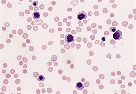 File:AML M6, blood smear.jpg   Wikimedia Commons