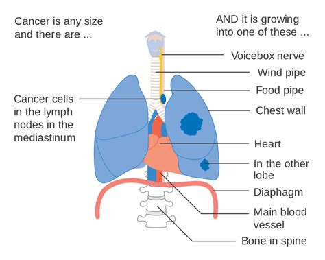 File:Diagram 2 of 2 showing stage 3B lung cancer CRUK 011 ...