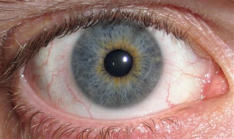 File:Eye Central Heterochromia crop and lighter.jpg ...
