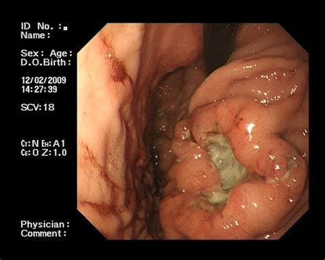 File:Gastric ulcer metastatic melanoma 01.jpg   Wikimedia ...