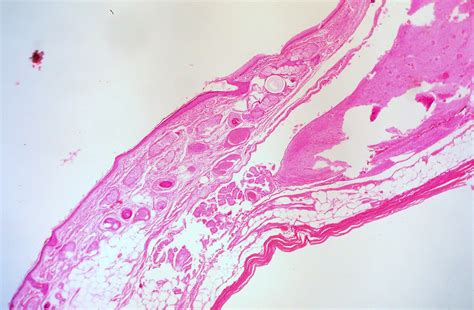 File:Mature Cystic Teratoma of the Ovary  3775467451 .jpg