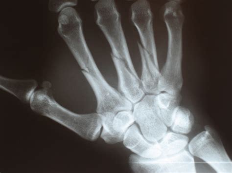 File:Metacarpal fractures.jpg   Wikipedia