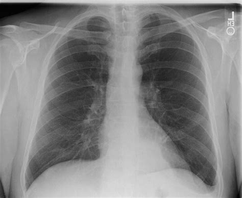 File:Pulmonary sequestration 002.jpg   Wikimedia Commons