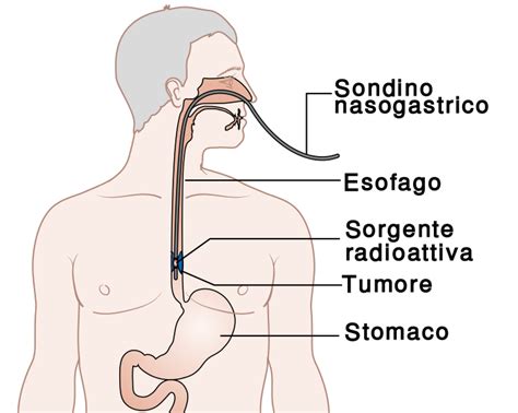 File:Radioterapia interna per tumore esofago.svg   Wikipedia