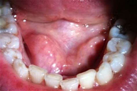 Floor of the Mouth Cancer | Singapore | PDF | PPT| Case ...