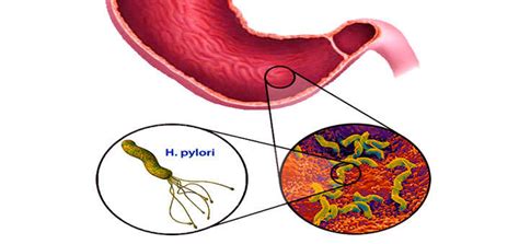 Formas de contagio por la bacteria Helicobacter pylori