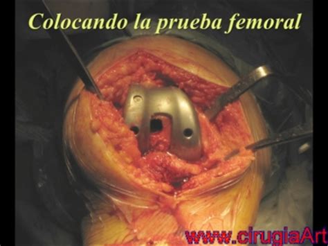 Fotografias de la cirugia abierta: Implantacion de ...