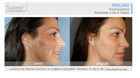 Fotos Antes y Después Peeling Facial Químico. Opiniones