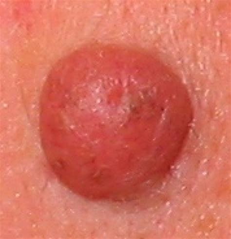 Fotos cancer de piel sintomas