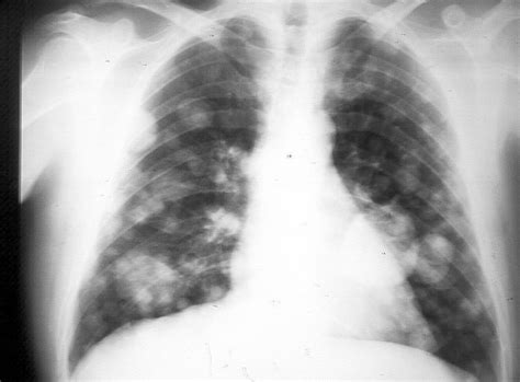 Fotos cancer de pulmon