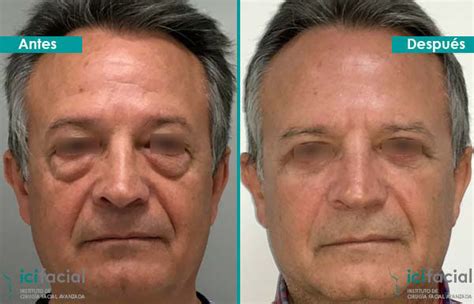 Fotos de blefaroplastia antes y después