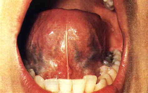 Fotos de cancer de lengua
