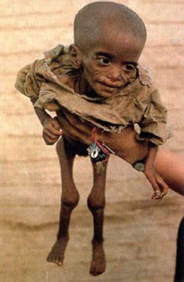 Fotos de los niño desnutridos de africa   Taringa!