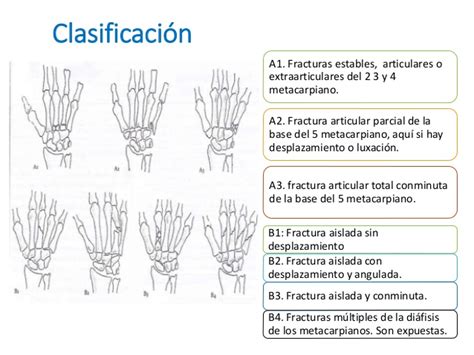 Fractura de la mano adriana