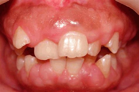 Full Text   Hereditary gingival fibromatosis: Report of ...