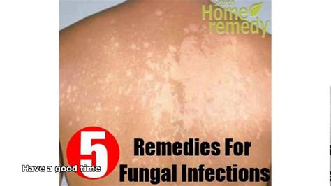fungal skin infection treatment   YouTube