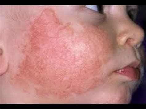 Fungal Skin Infections Pictures   Remedies Exchange