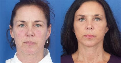 Gallery | Crawford Plastic Surgery