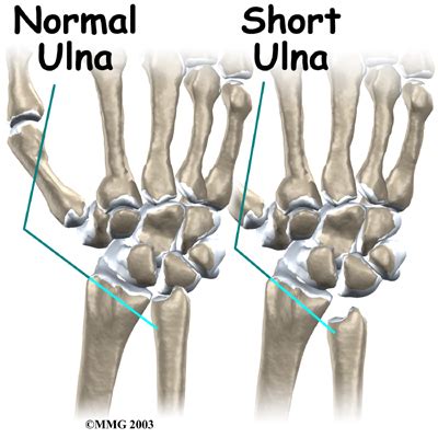 Gallery: Ulna Bone Wrist,   Anatomy Diagram Charts