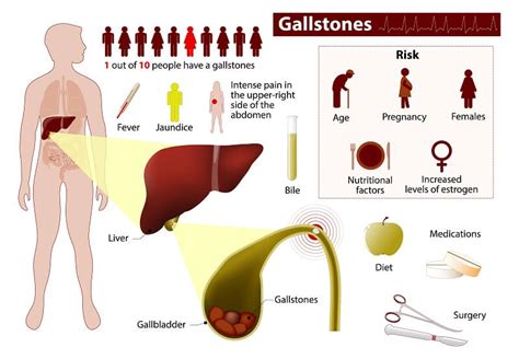 Gallstones Diagnosis Medical Negligence Claims Solicitors ...