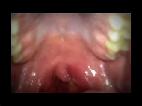 Garganta con anginas, amigdalas con pus. laringitis   YouTube