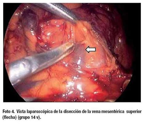 Gastrectomía Distal Laparoscópica por Cáncer Gástrico ...