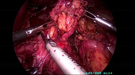 Gastrectomia subtotal totalmente laparoscópica   cirurgia ...