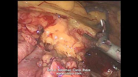 Gastrectomia total laparoscópica por cáncer gástrico de 1 ...