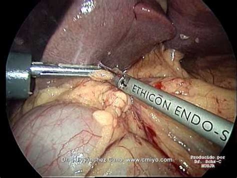 gastrectomia total por laparoscopia   Videos | Videos ...