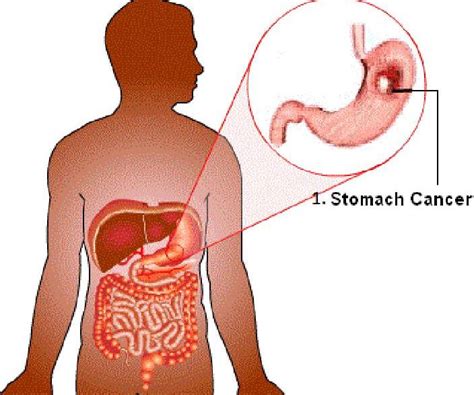 Gastric Cancer | CancerQuest