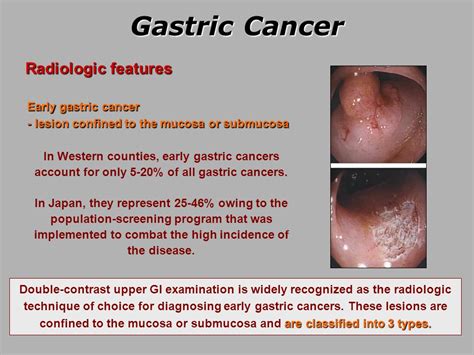 Gastric Cancer.   ppt video online download