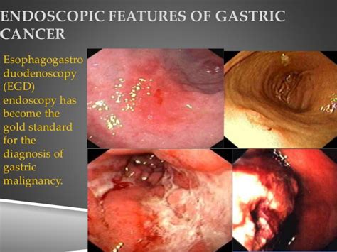 Gastric Cancer   stomach tumor