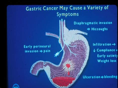 Gastric Cancer   The Clinical Advisor