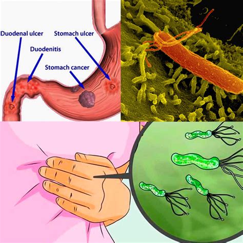 Gastritis Por Helicobacter Pylori: Síntomas, Cómo Se ...