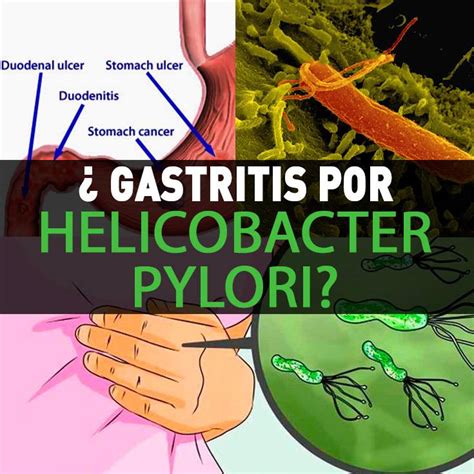 Gastritis Por Helicobacter Pylori: Síntomas, Cómo Se ...